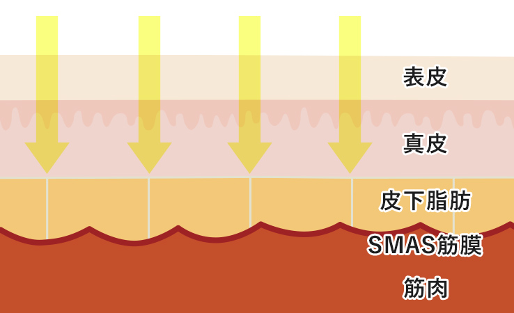 フォトフェイシャルのしくみ